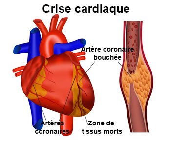 Infarctus : ces 2 facteurs inattendus triplent le risque #infarctus #sante #PréventionSanté #TvLocale-fr